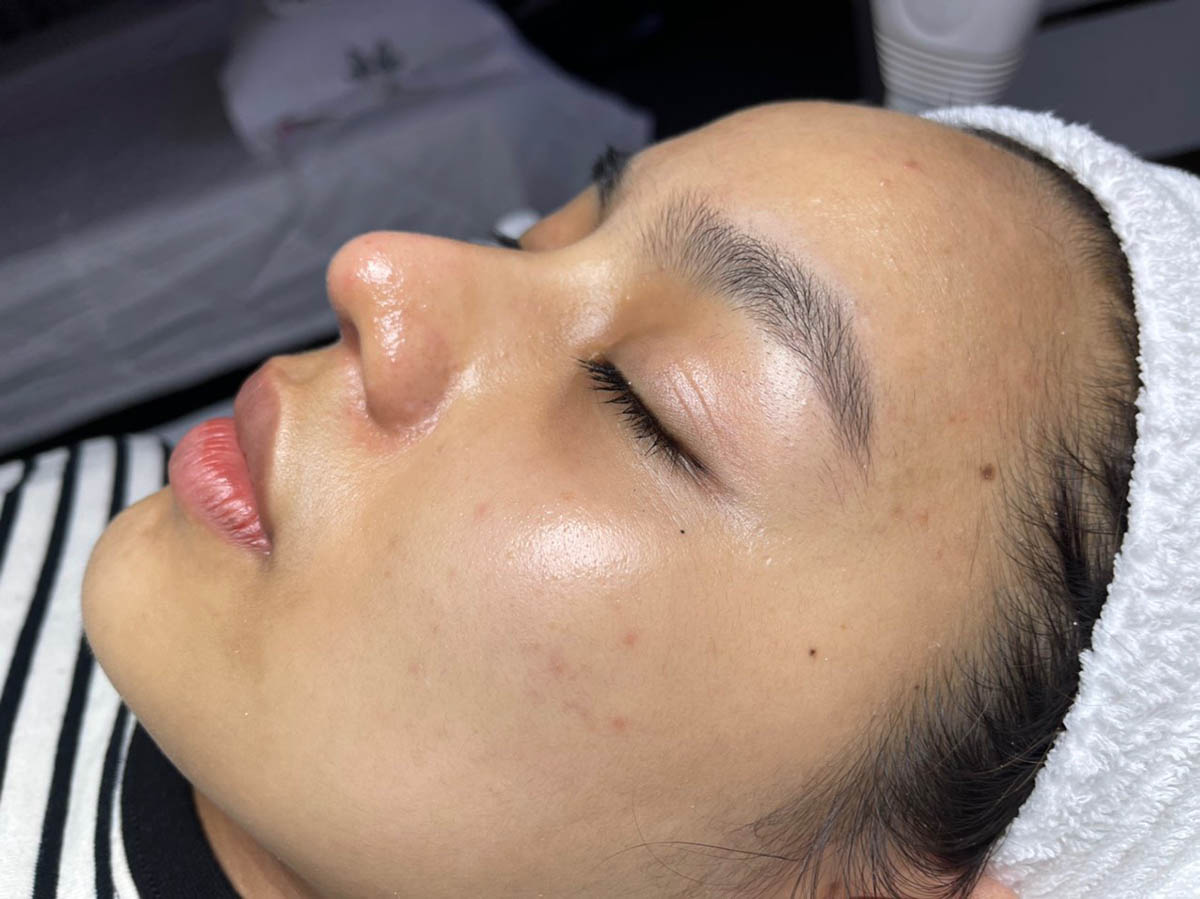 Sau Điều Trị Mụn Nội Tiết tại Long thành