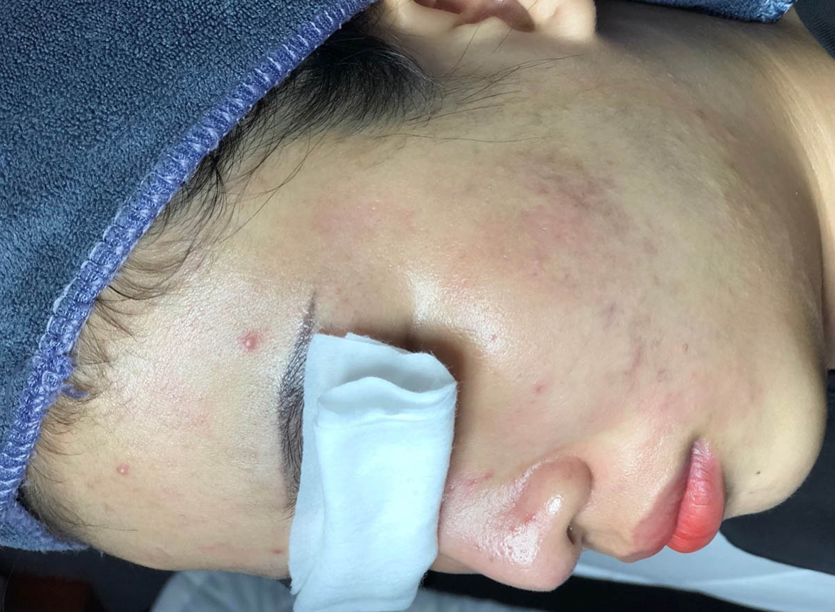 Sau Khi Trị Mụn Khoa Học tại Long Thành Hiệu Quả