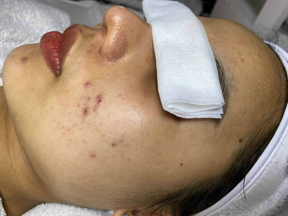 Trước Điều Trị Mụn Nội Tiết tại Long thành