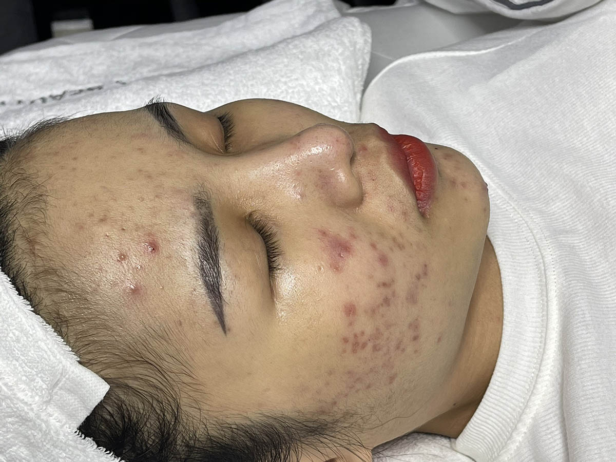 Trước Khi Trị Mụn Khoa Học tại Long Thành