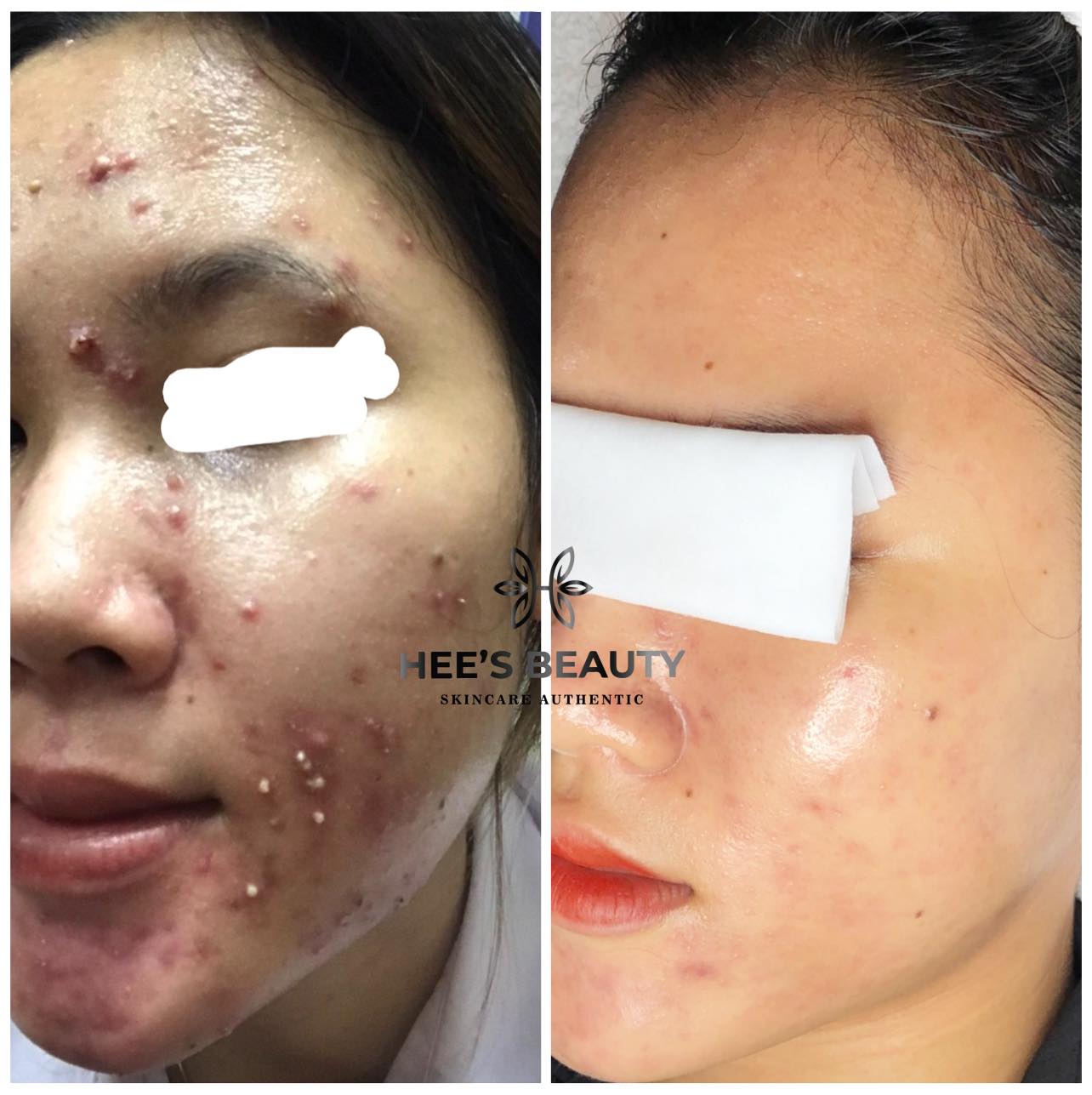 Trị Mụn Dậy Thì Long Thành Uy Tín