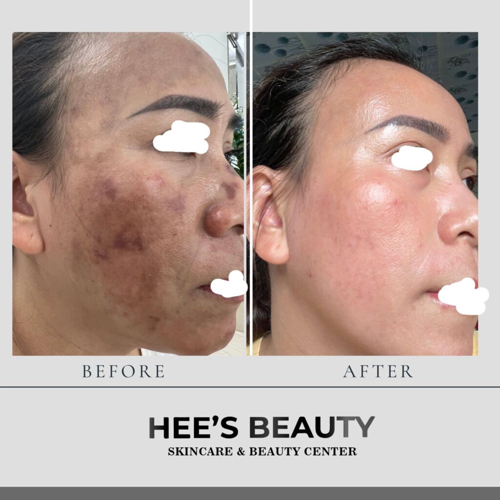 Before After Review Spa Skincare in HCMC