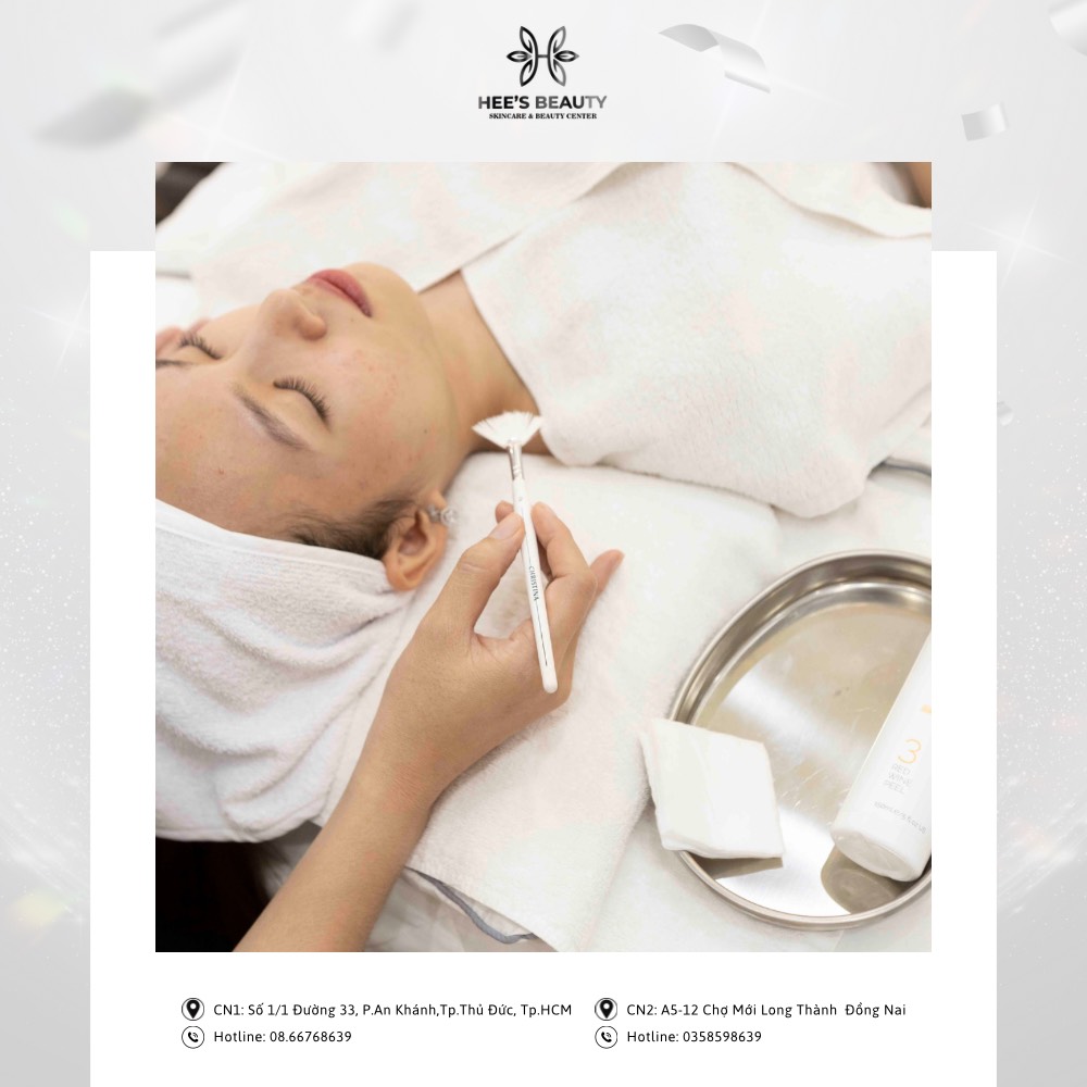 Phương pháp peel mụn trứng cá