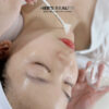Chemical Peel điều trị mụn