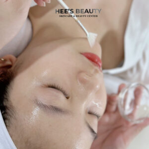 Chemical Peel điều trị mụn