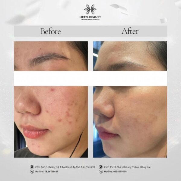 Acne treatment in District 2