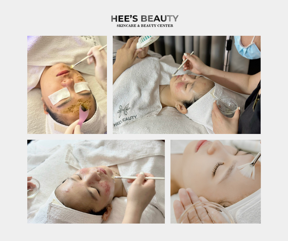 Dịch vụ chemical peel
